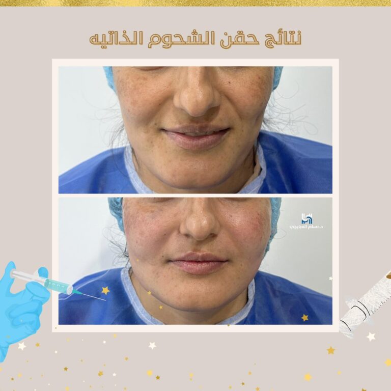 حقن السحوم الذاتيه 768x768