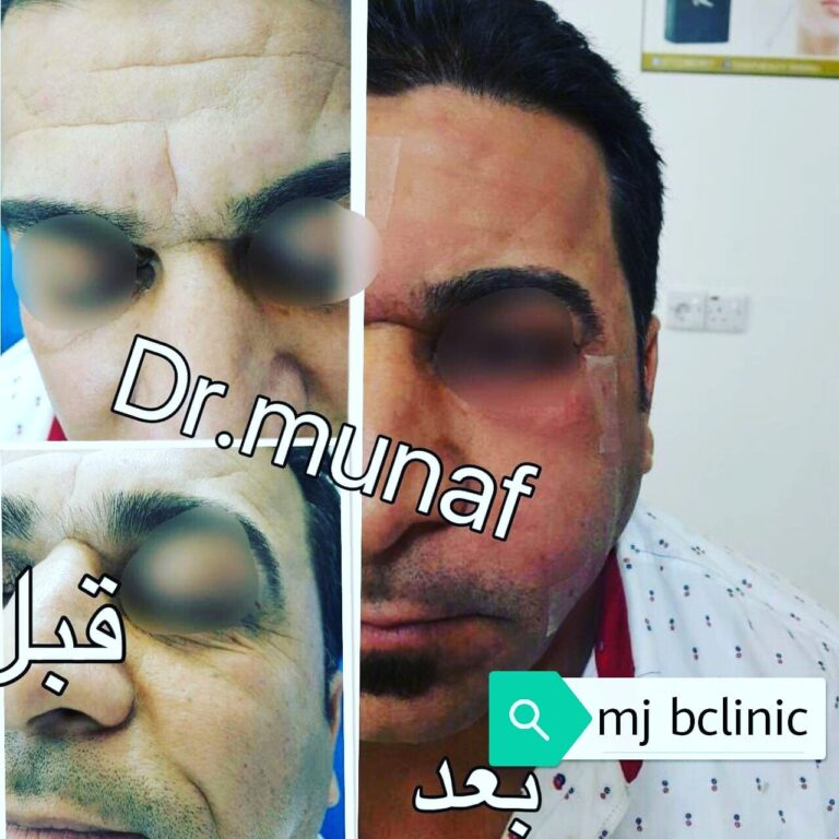 حقن الشحوم 768x768