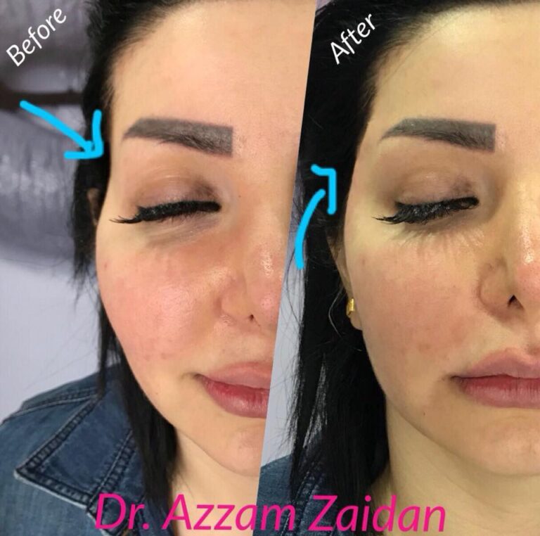 حقن الصداغ 768x762