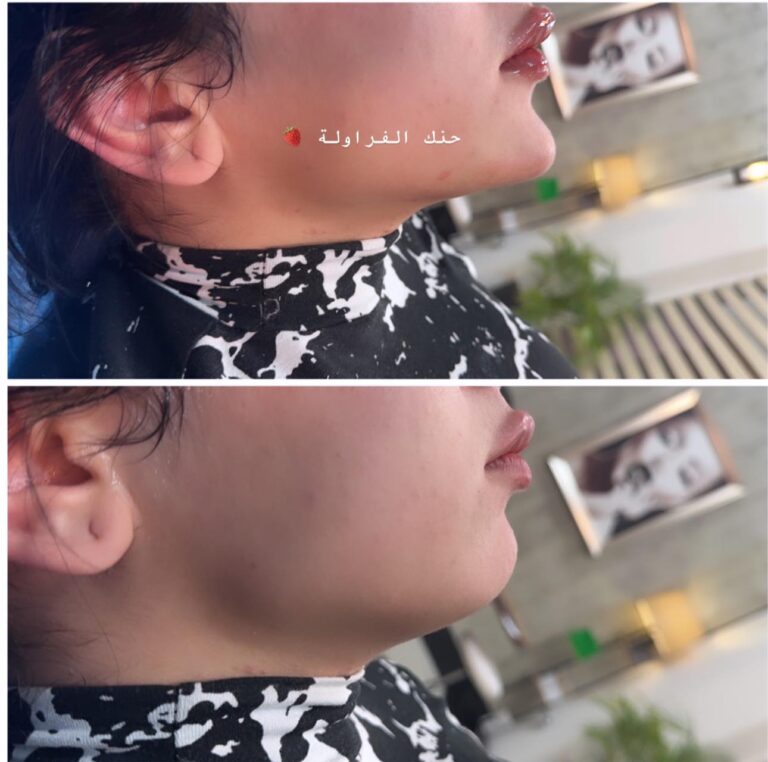 حقن الفراوله 768x762