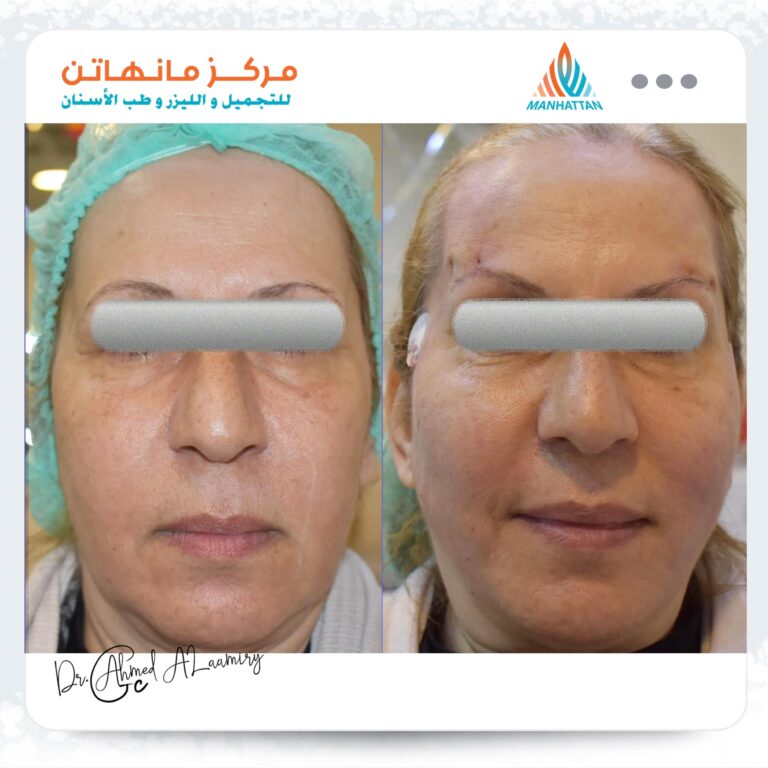 حقن الوجه 768x768