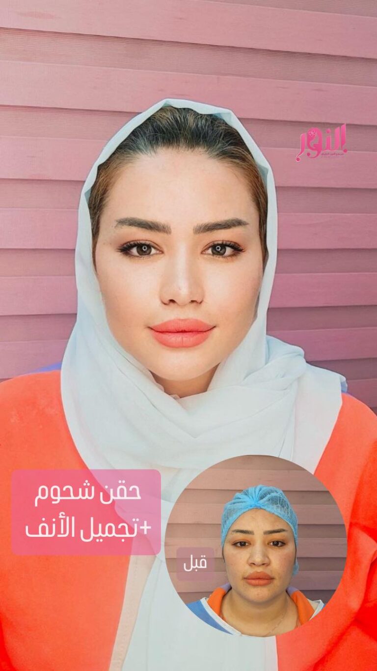 حقن شحوم 1 768x1365