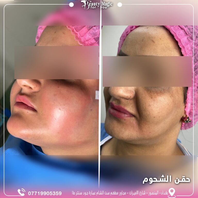 حقن شحوم 768x768