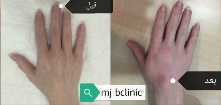 حقن شحوم اليد 768x367