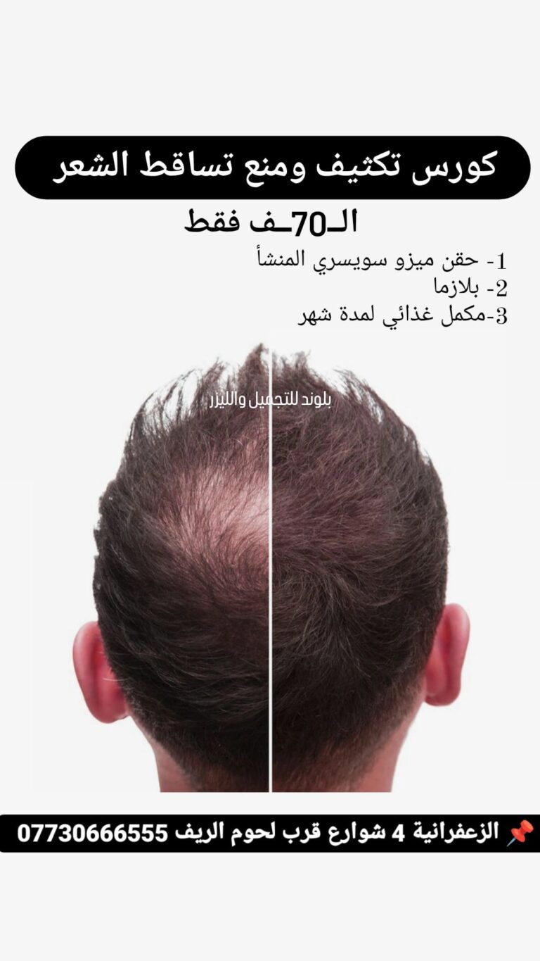 حقن شعر بلازما 768x1365