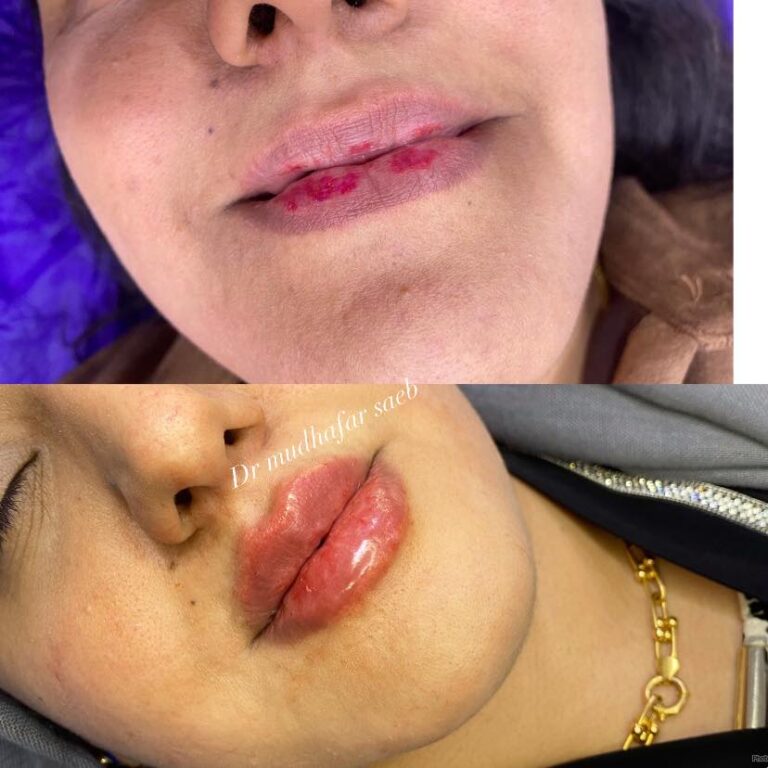 حقن فلر 2 768x768