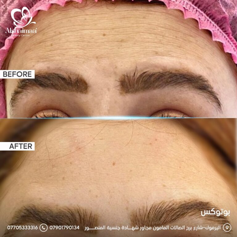 حقن لازالة تجاعيد الجبين 768x768