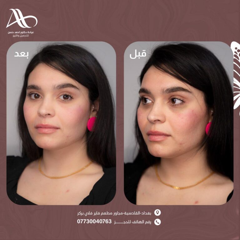 حقن للهالات السوداء 768x768