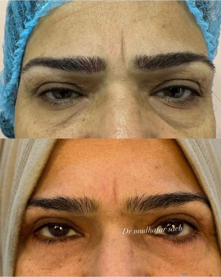 حقن وجه 768x961