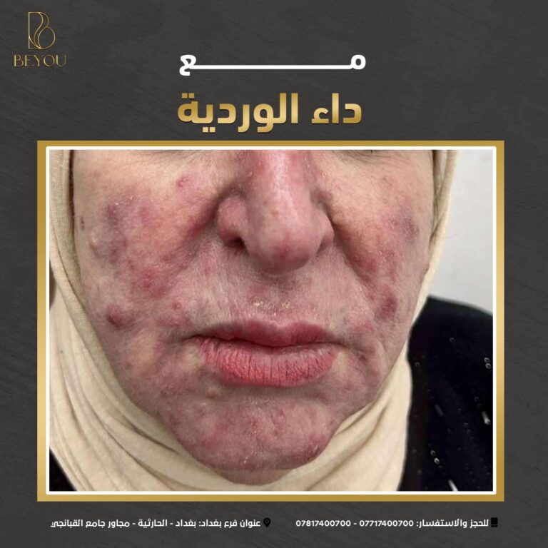 داء الوردي 768x768