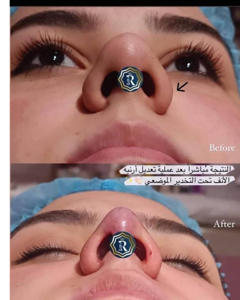 رفع الانف 768x960