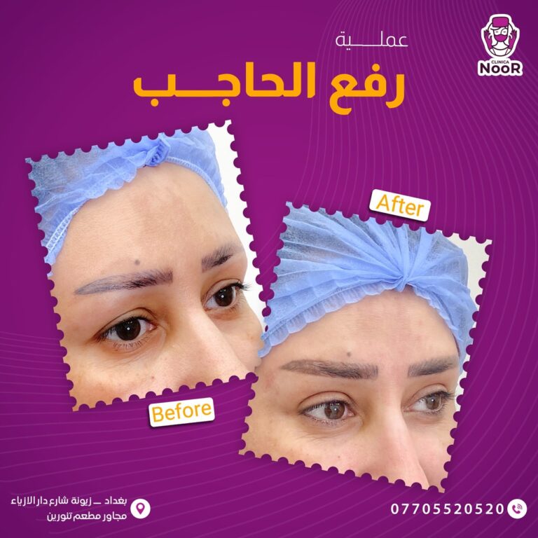 رفع الحاجب 1 768x768