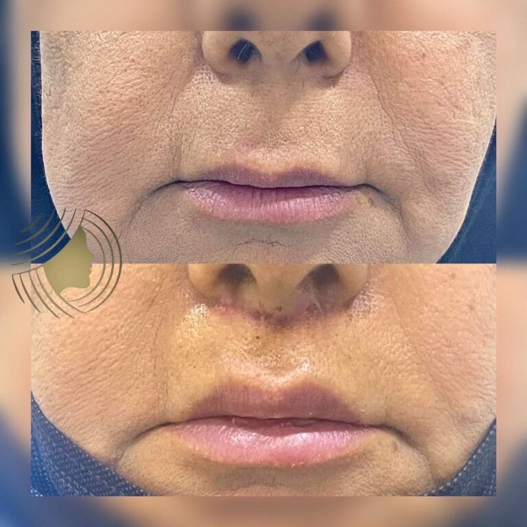 رفع شفاه 768x768