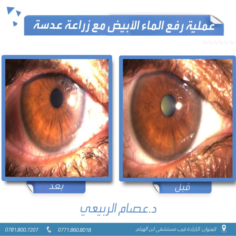 رفع ماء العين 768x768