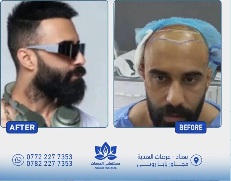 زراع شعر 768x604