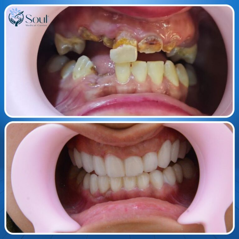 زراعة اسنان 1 768x768