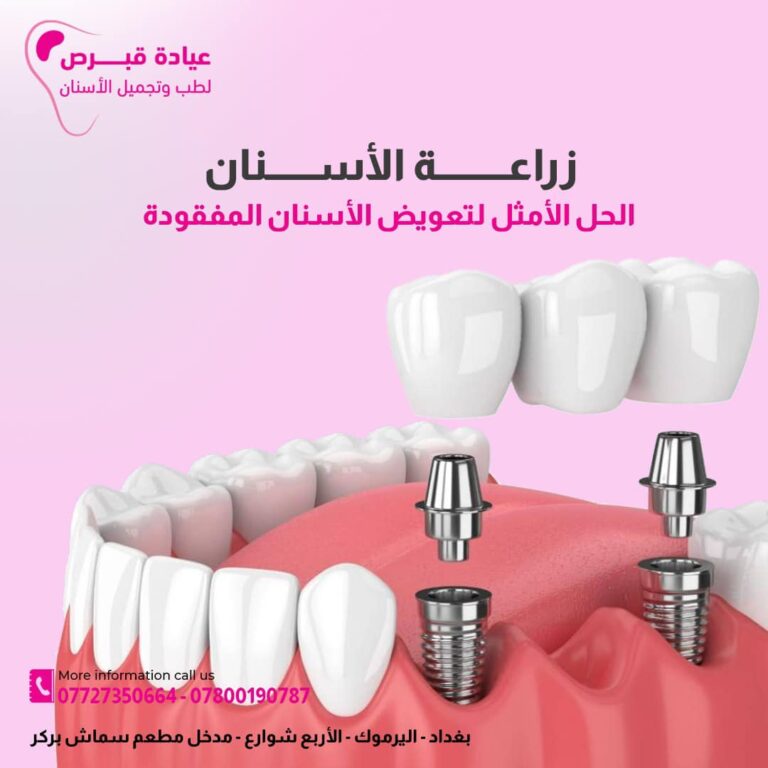 زراعة اسنان 3 768x768