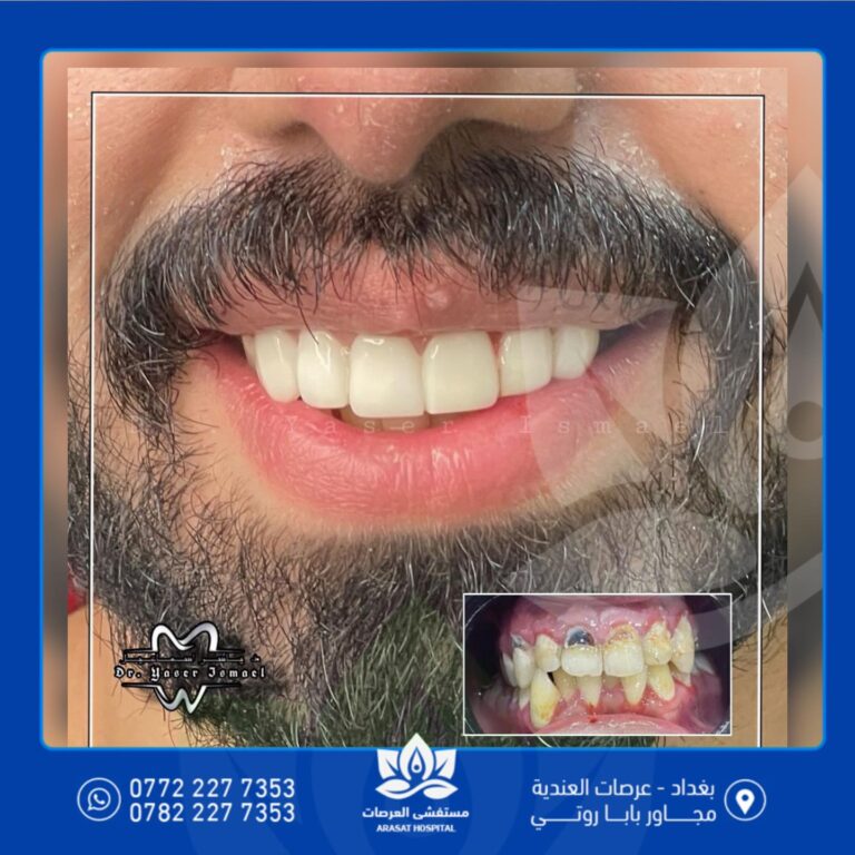 زراعة الاسنان 768x768