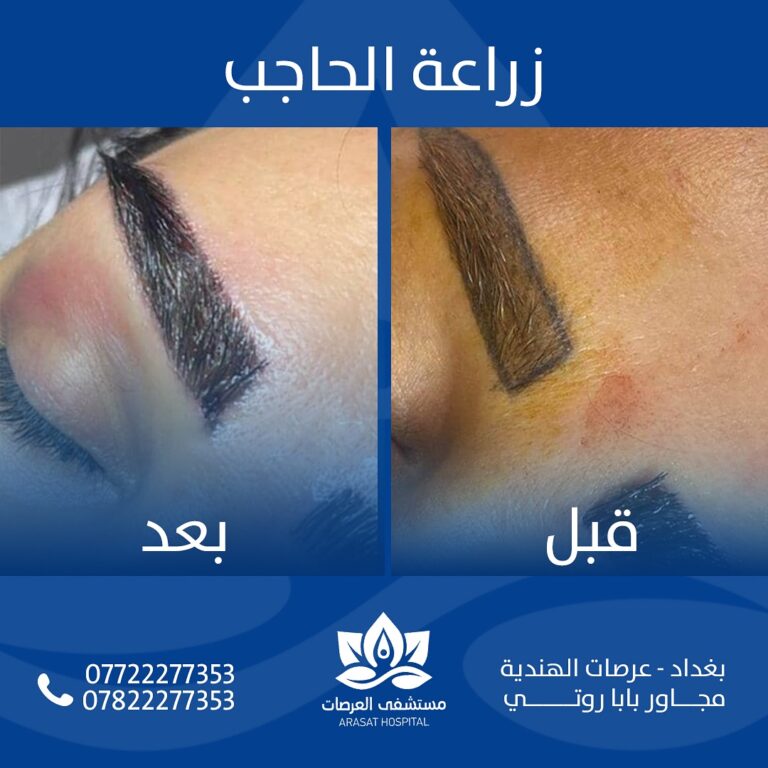 زراعة الحاجب 768x768