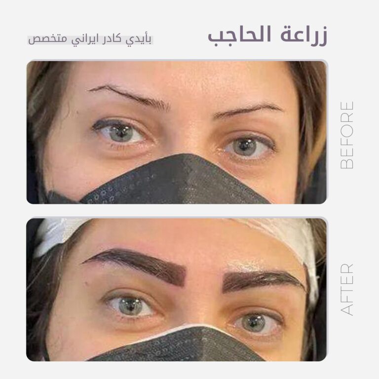 زراعة حاجب 768x768