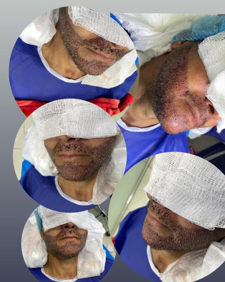 زراعة ذقن 768x960