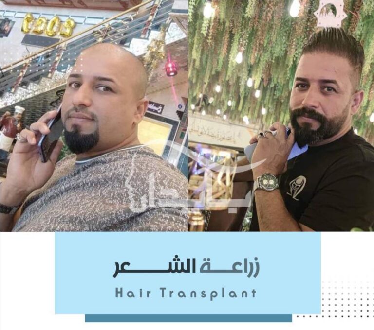 زراعة شعر 1 768x679