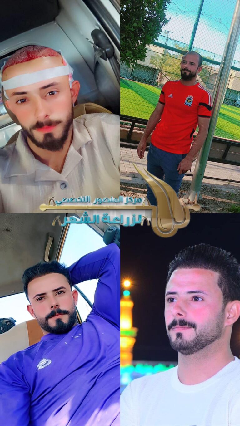 زراعة شعر 2 768x1365