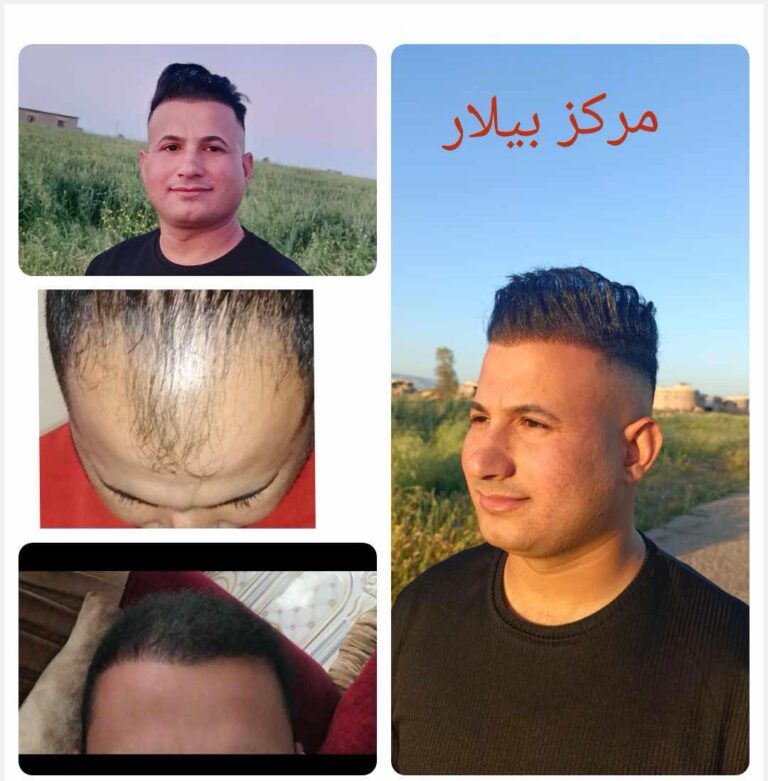 زراعة شعر 3 768x781