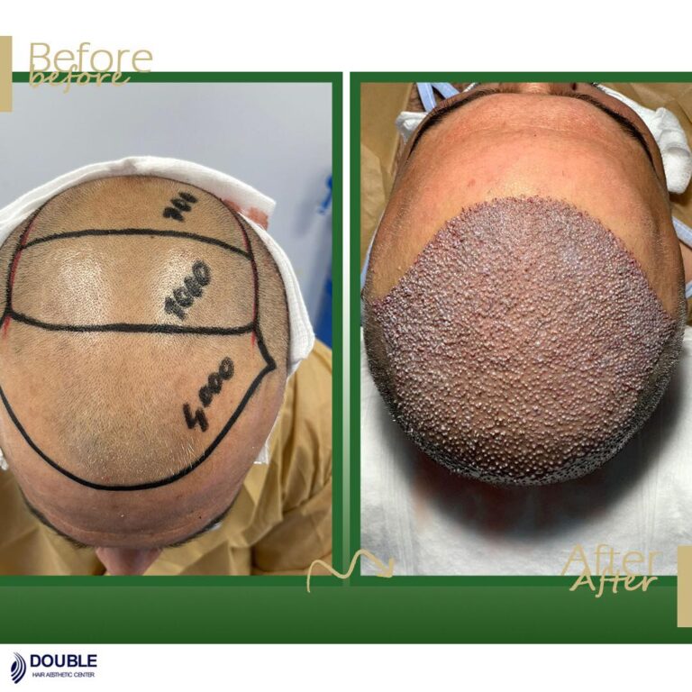 زراعة شعر 5 768x768