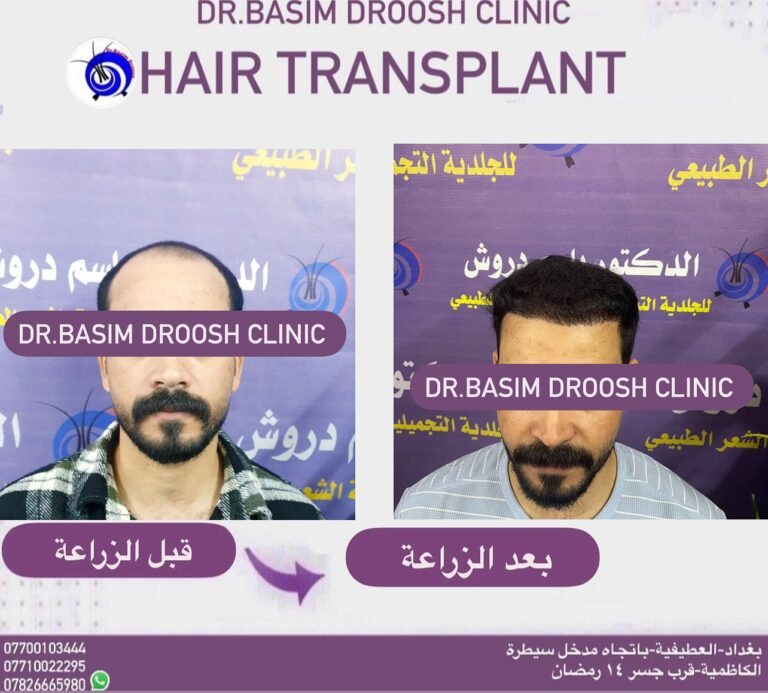زراعة شعر 6 768x693