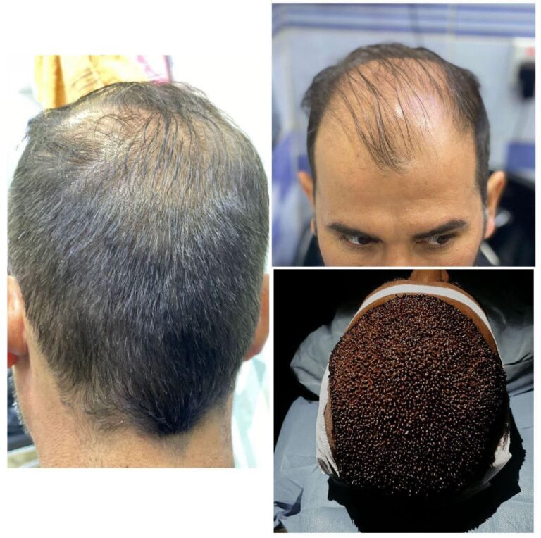زراعة شعر 7 768x764