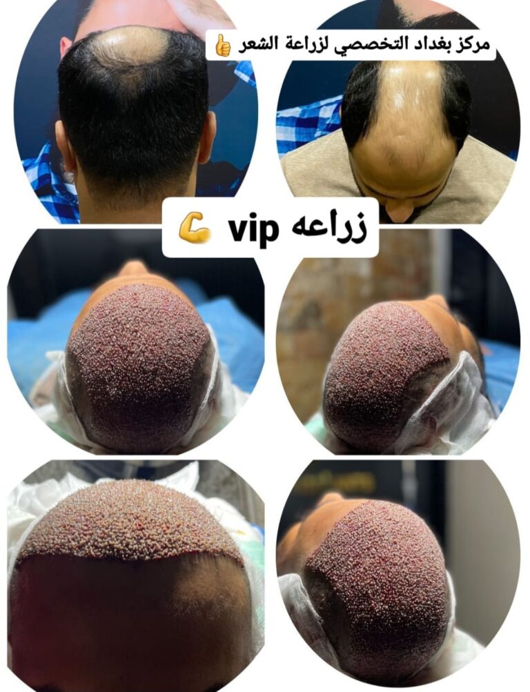 زراعة شعر 768x1003