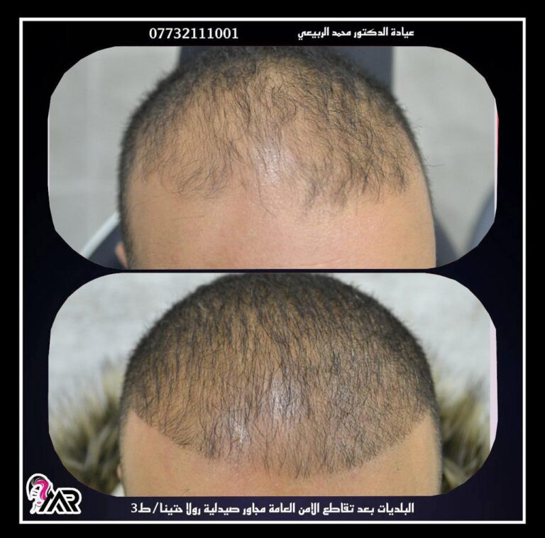 زراعة شعر 8 768x758