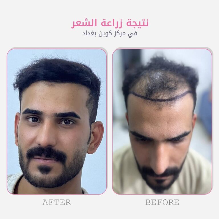 زراعة شعر 9 768x768