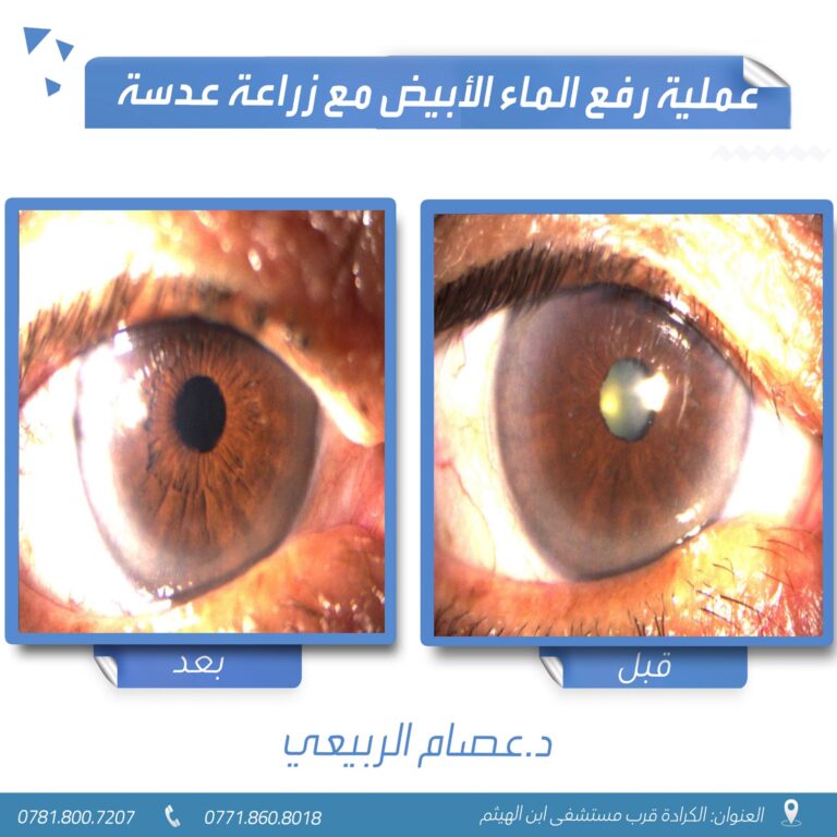 زراعة عدسه 768x768