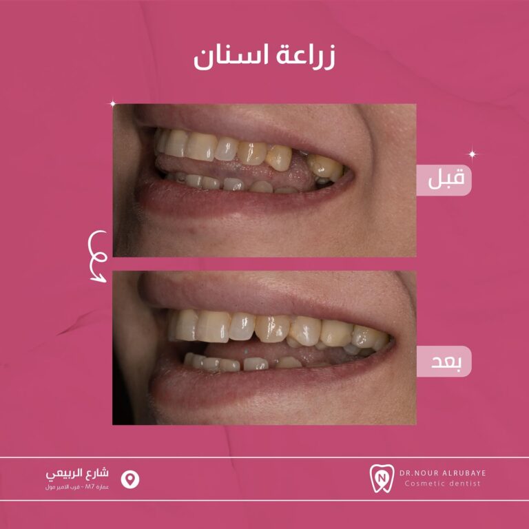 زراعه اسنان 768x768