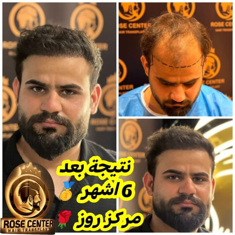 زراعه شعر 1 768x768