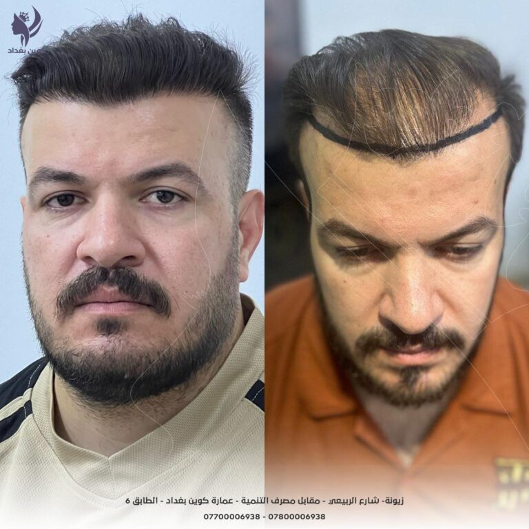 زراعه شعر 768x768