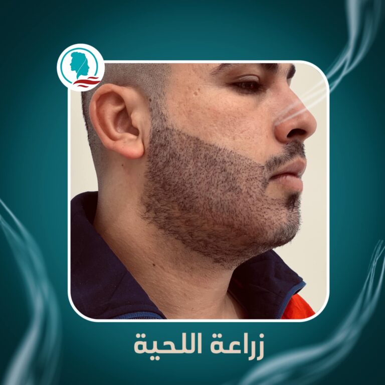 زراعه شعر الليحه 768x768