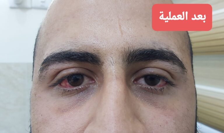 زراعه قرنيه 768x456