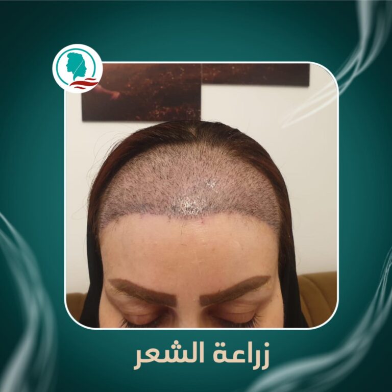 زراعه للنساء 768x768