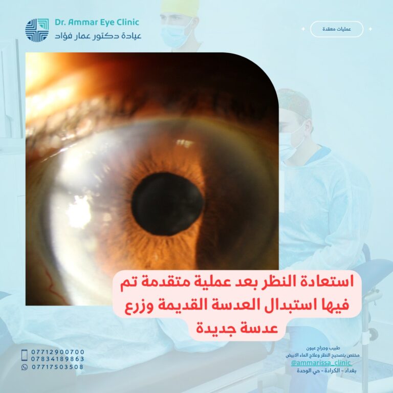 زرع العدسه 768x768