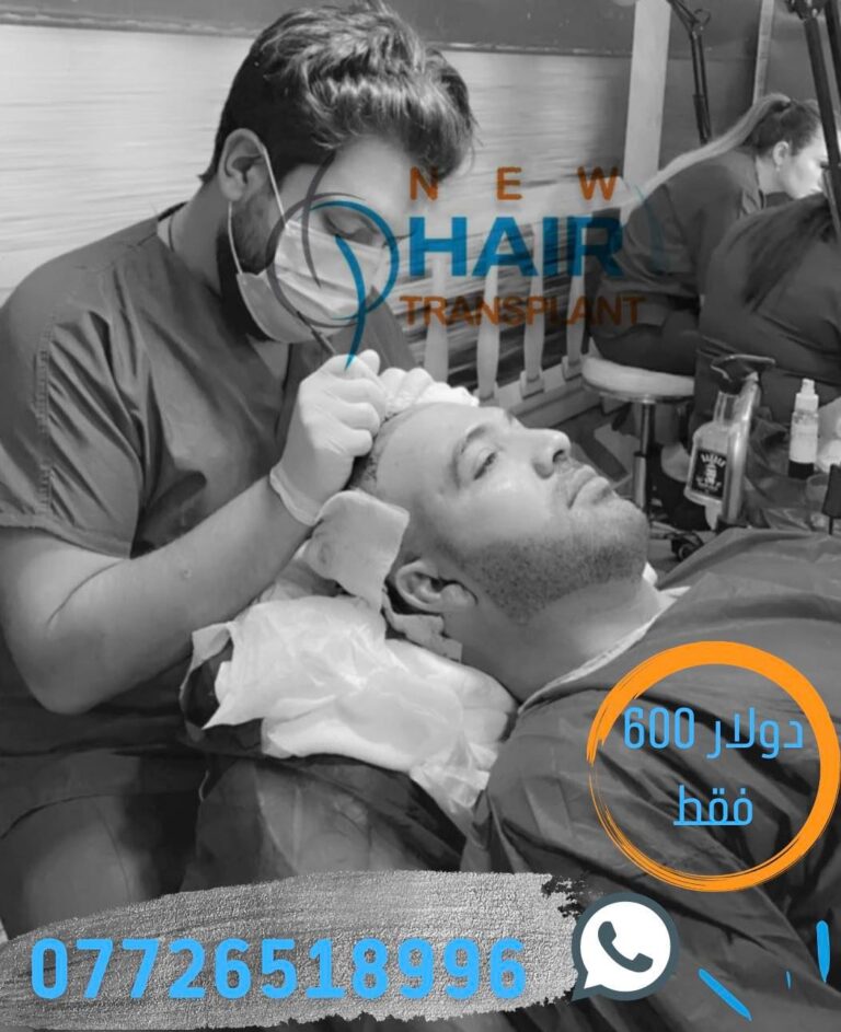 زرع شعر 768x943