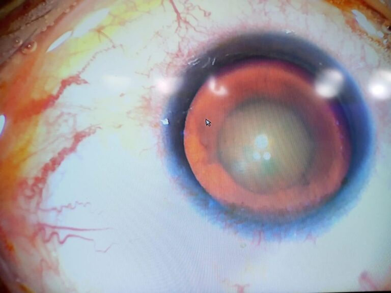 زرع عدسه 1 768x575