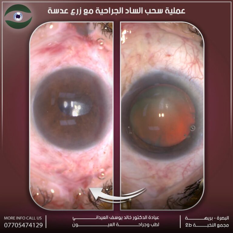 زرع عدسه 768x768