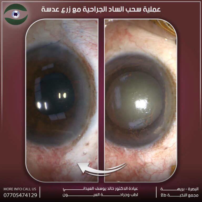 سحب الساد جراحيا 768x768