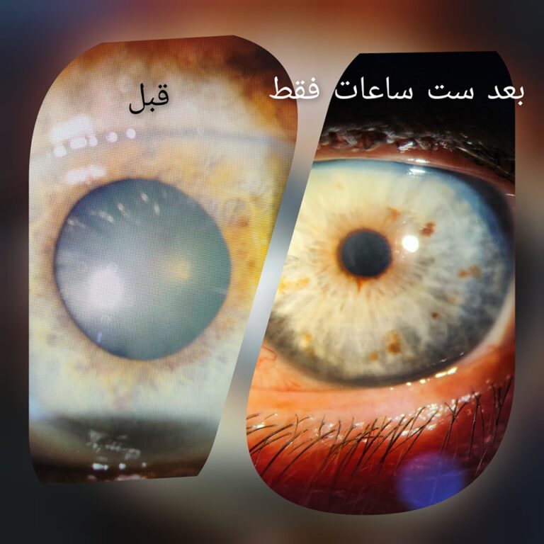 سحب ماء قبل وبعد 768x768