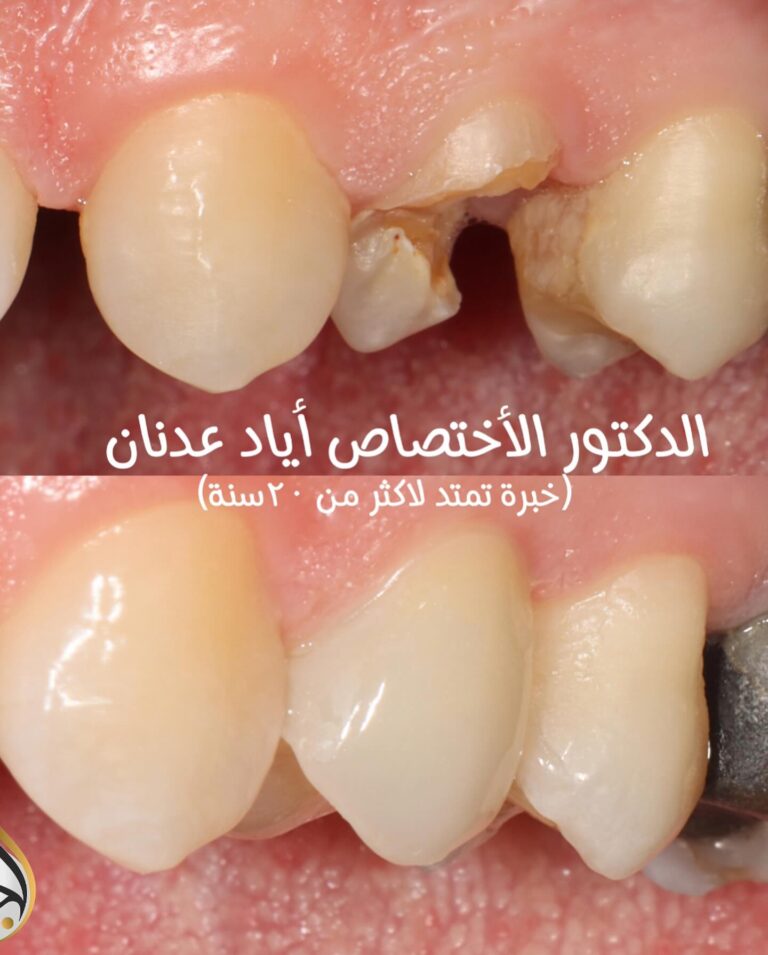 سد الفراغات اسنان 768x955