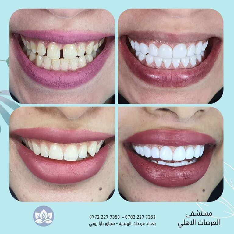 سد فراغ اسنان مع تبيض 768x768