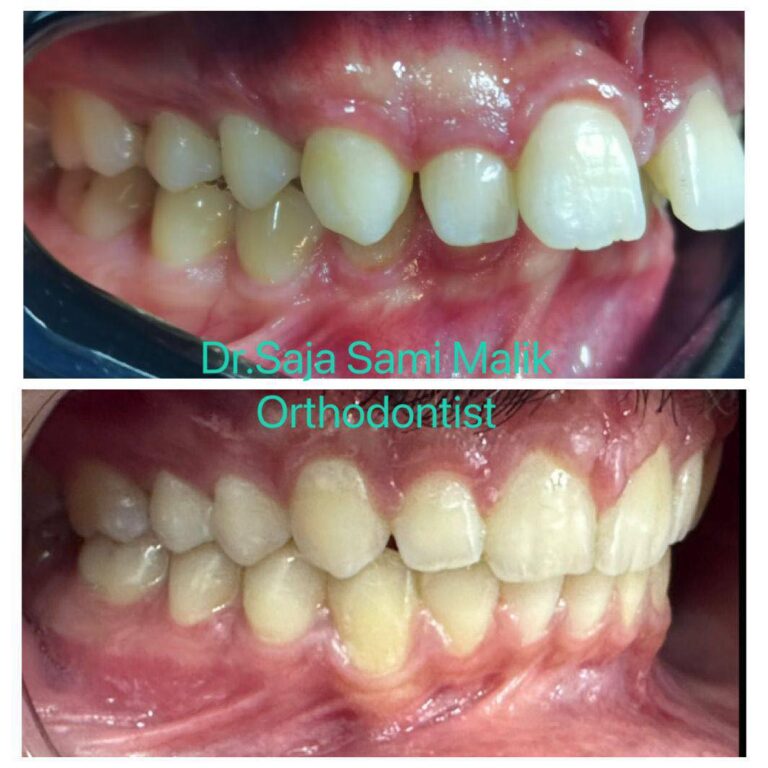 سد فراغات الاسنان 768x768